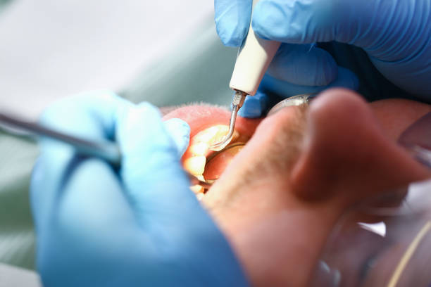 Best Emergency Treatment for Dental Infections or Abscesses in Tonawanda, NY